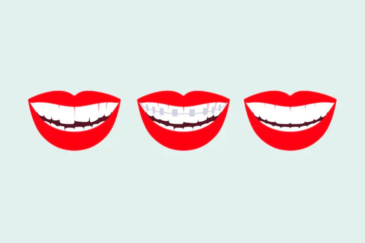 An illustration of teeth straightening process