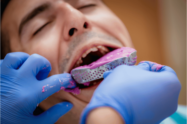 Tips to take good dental impressions