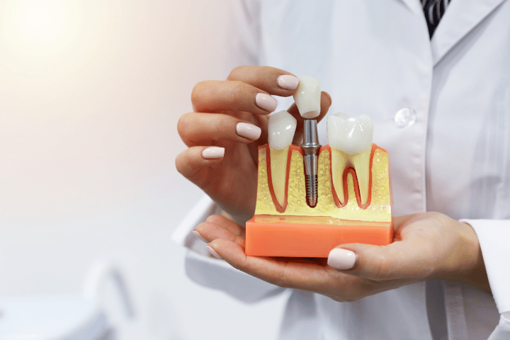 Fix overjet with clear aligners