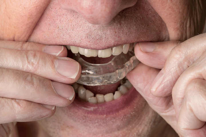 Teeth Whitening for Tetracycline Stains