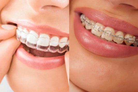 An illustration showing the types of braces.