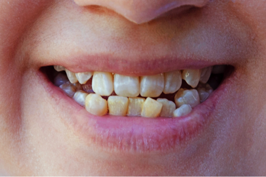 A guy smiling with white spots on his teeth