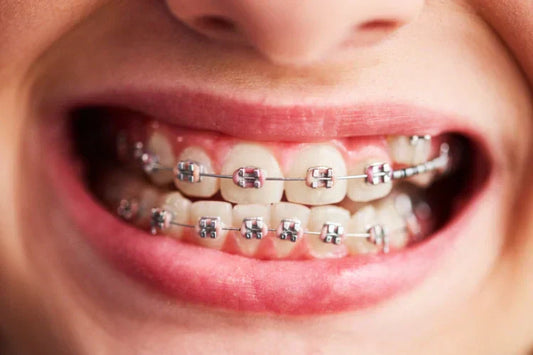 A close-up image of braces applied to teeth