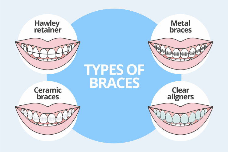 Exploring the Various Types of Braces for Dental Treatment - SmilePath
