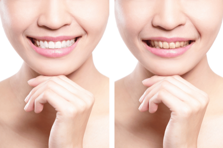 Teeth Whitening Tips for Tea and Herbal Infusion Drinkers