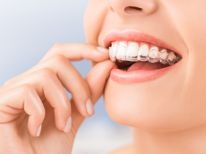 Additinal Retainers