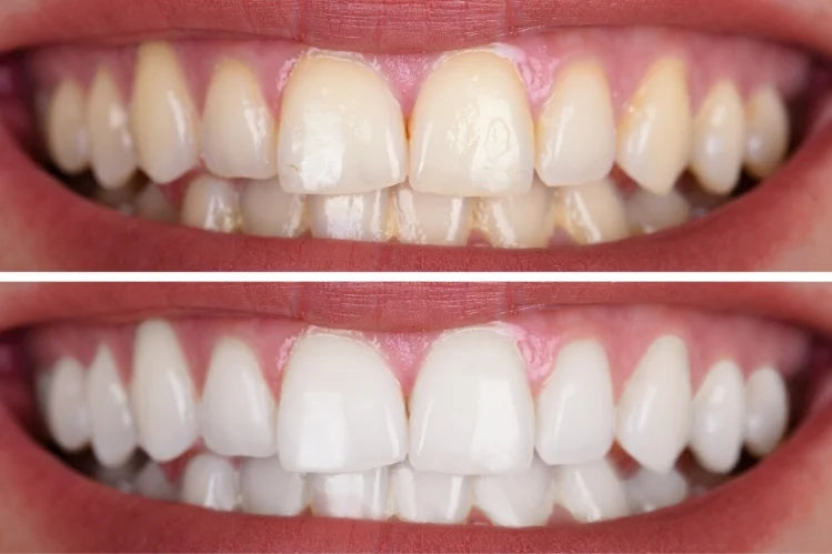 before and after of whitened teeth