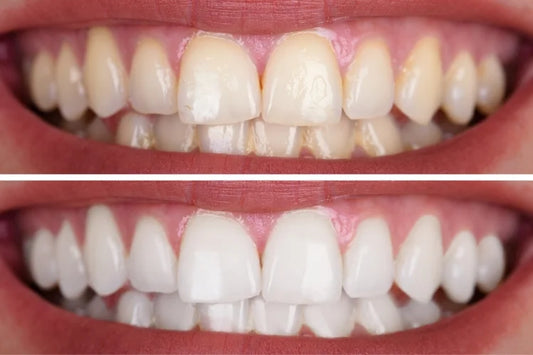 before and after of whitened teeth