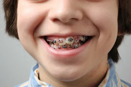 A_child_having_crooked_teeth_with_braces