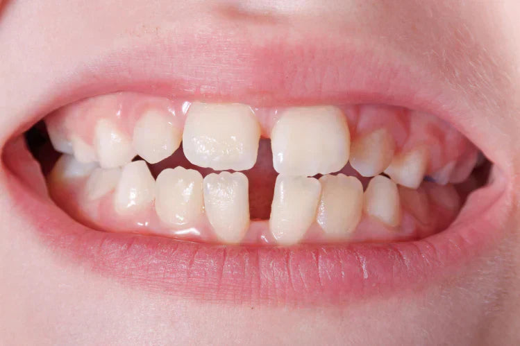 A close-up image of a child with gaps in teeth