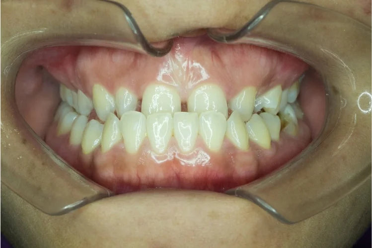 A close-up of an underbite
