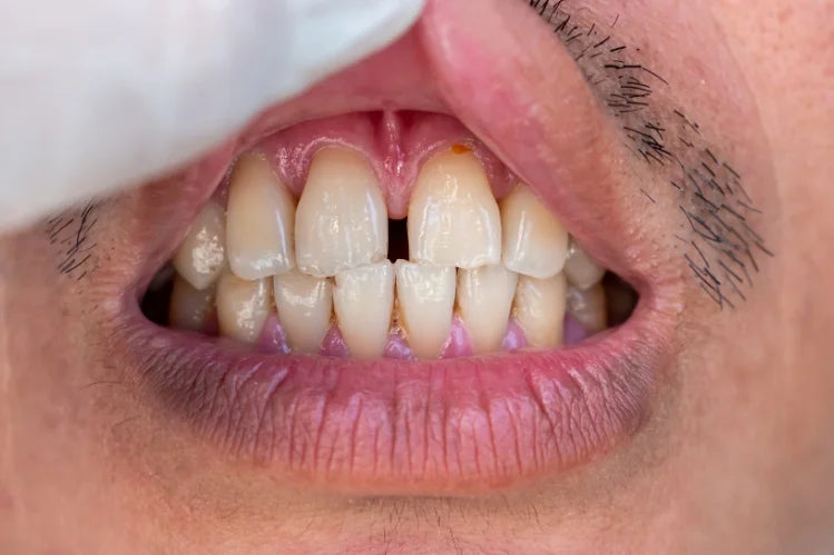 A guy showing his teeth with a gap between the front teeth