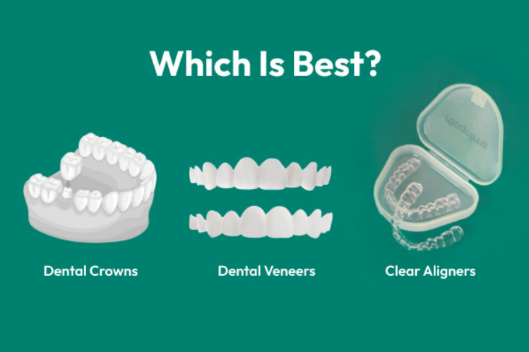 A side-by-side visual comparison of dental crowns, veneers, and clear aligners.