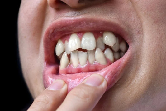 A visual representation of an individual suffering from teeth crowding