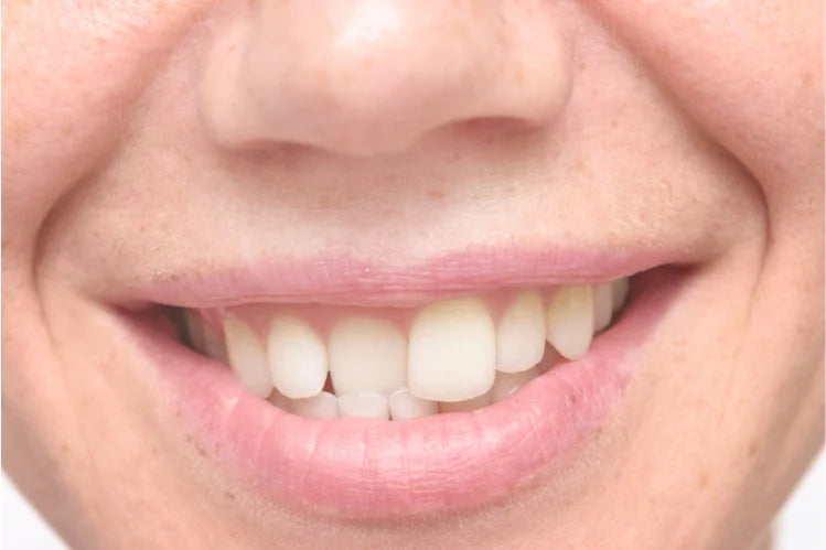 A woman showing her slanted front tooth