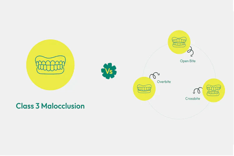 An Illustration of class 3 malocclusion vs other bite issues