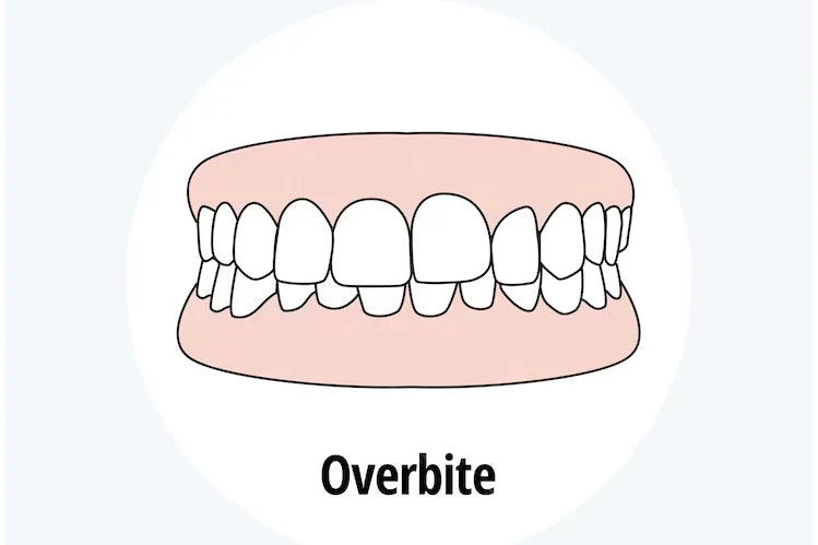 An illustration of what teeth look like with a class Ⅱ malocclusion