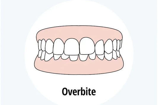 An illustration of what teeth look like with a class Ⅱ malocclusion