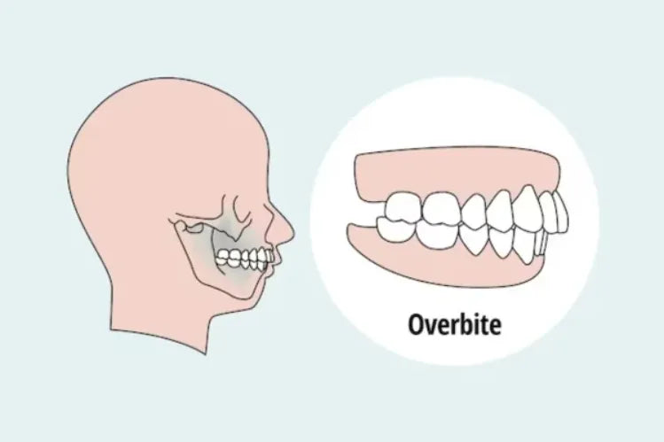 A pictorial illustration showing an overbite.