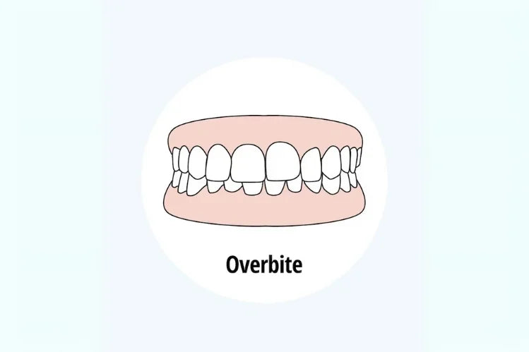 An image of an overbite