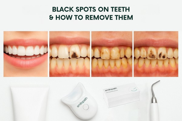 An image shows black spots on teeth and treatment options to remove them