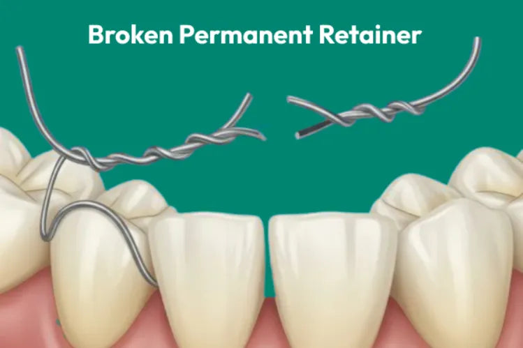 an illustration of teeth with a broken permanent retainer
