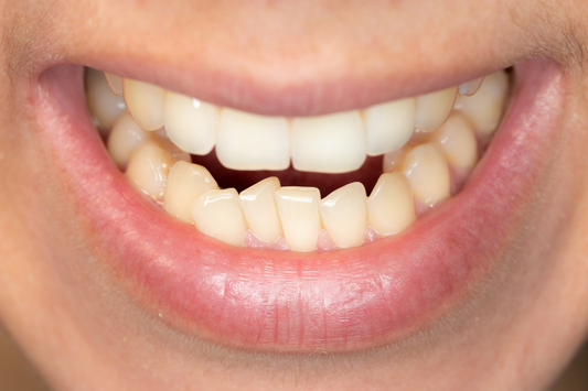 A close-up of a man with crowded teeth in the lower jaw.