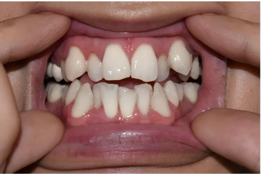 Lower and upper crowding teeth