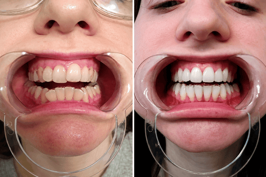 Crowded teeth before and after wearing clear aligners.