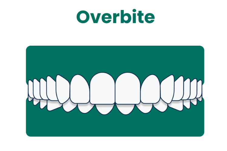 An illustration showing an overbite.