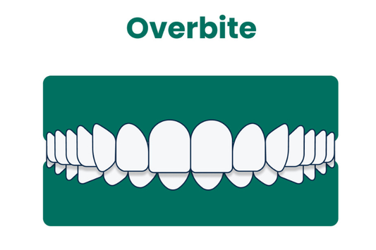 An illustration showing an overbite.