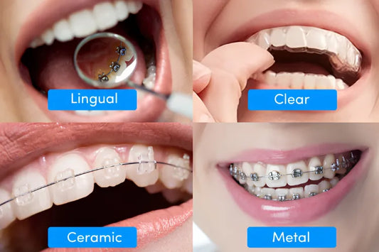 Different types of adult braces for a perfect smile.