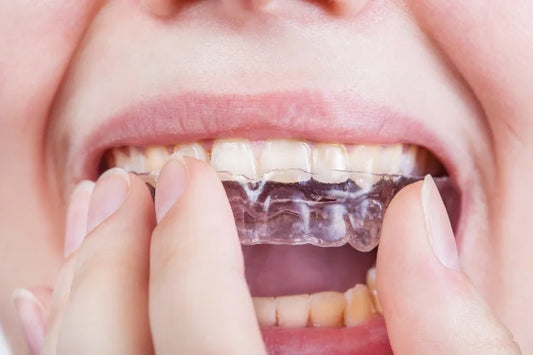 Clear Aligner Treatment