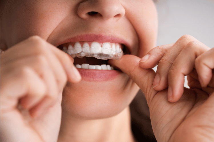 Clear Aligners and Oral Health