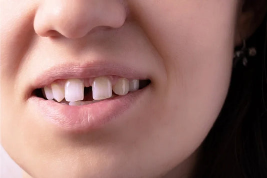 Closeup of a woman showing her gap teeth