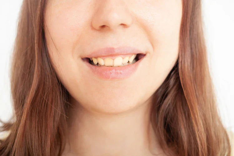 Crooked Teeth