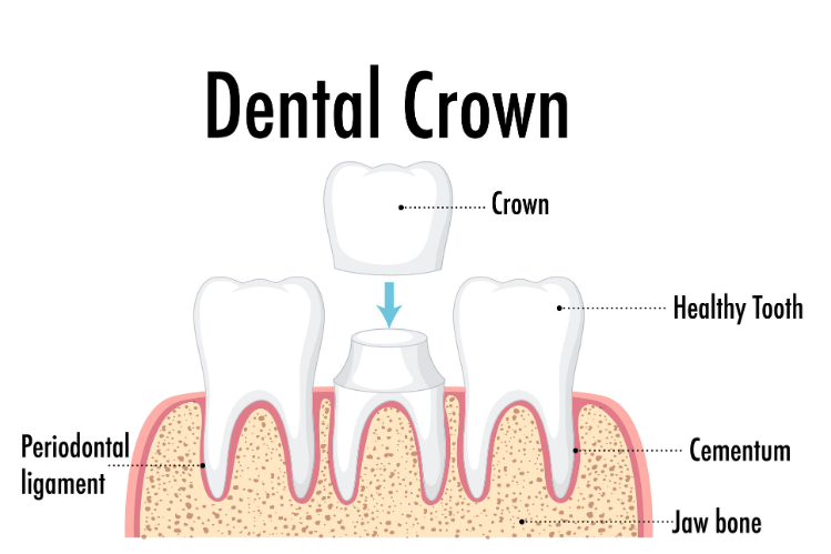 Dental crown being placed