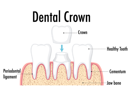 Dental crown being placed
