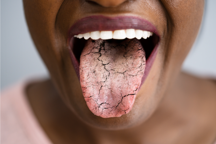 A close-up image of a woman with a cracked tongue