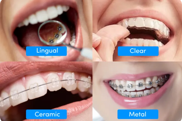 What Types of Braces Are Best for Teenagers?