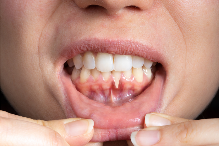 A close-up of a girl suffering from gum recession.