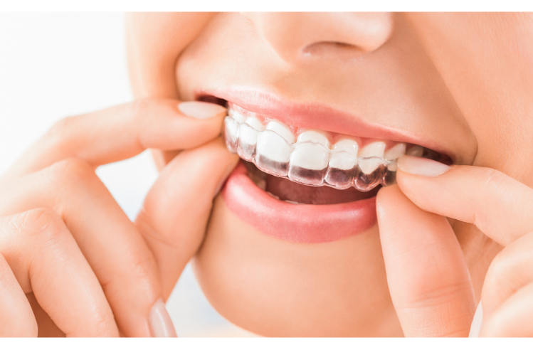 A woman removing aligners