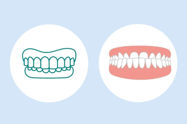 illustration of how different underbite and overbite look like