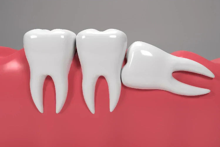 Illustration of posterior teeth issue