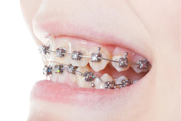 Close-up of metal braces on teeth