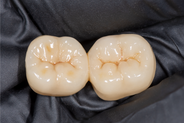 An image of two ceramic molar crowns.