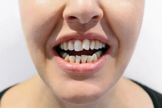 a woman showing her crooked teeth