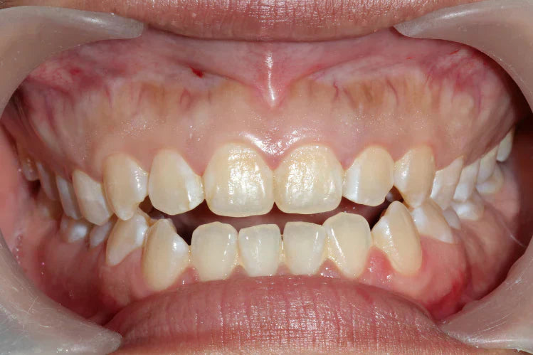  A close-up of an open bite