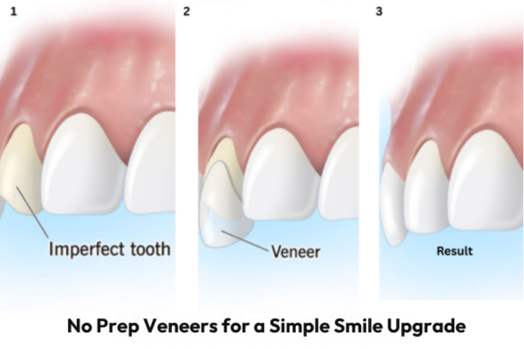 Process of how no-prep veneers work 
