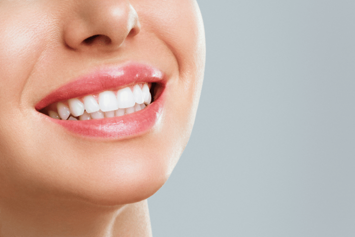 Clear Aligners and Teeth Whitening